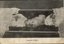 Emilisa Stoll, Siamese Twins Emilisa Stoll, Siamese Twins